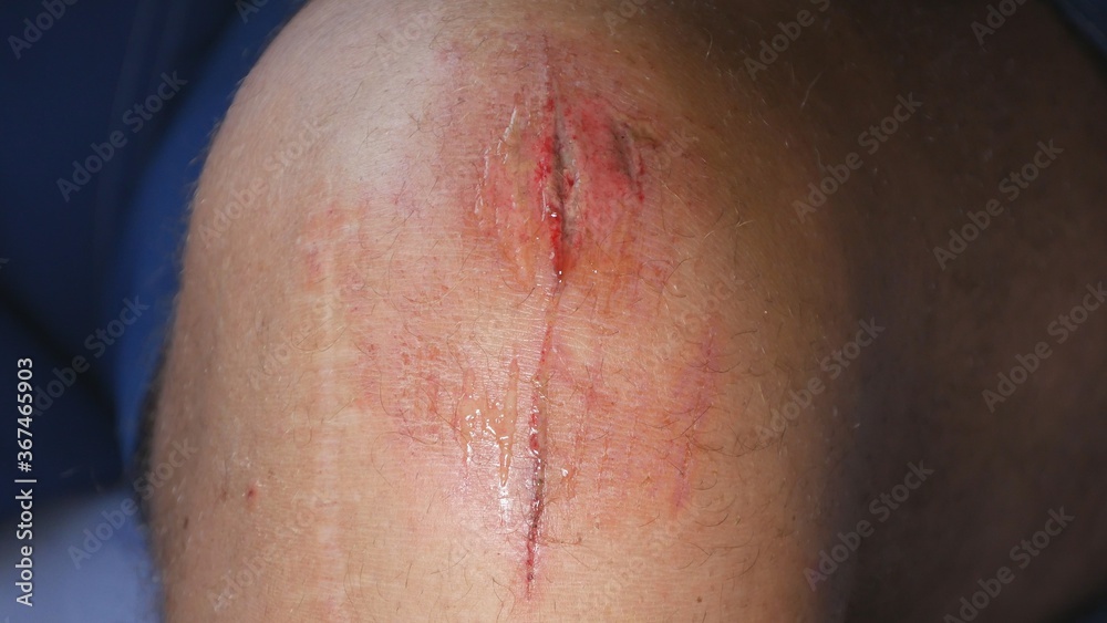 Fototapeta premium Doctor Cleaning Infected Foot Wound Using Medical Disinfectant and Bandage in Hospital Emergency Room