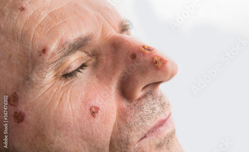 Wound from laser on a face from dermatologist