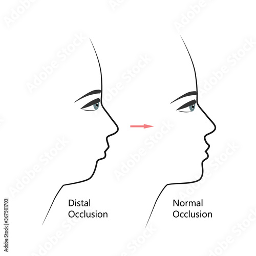 Distal bite profile before and after orthodontic treatment. Human with malocclusion, lower jaw pushing back, bite correction by braces. Vector illustration