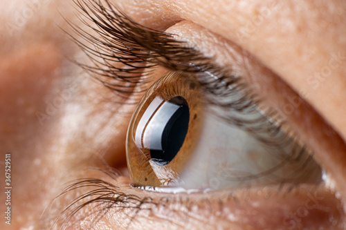 Keratoconus of eye, 3th degree. Contortion of the cornea in the form of a cone, deterioration of vision, astigmatism. Macro close up