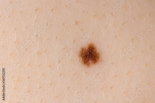 Mole birthmark nevus macro photo on human skin. Close up. photo
