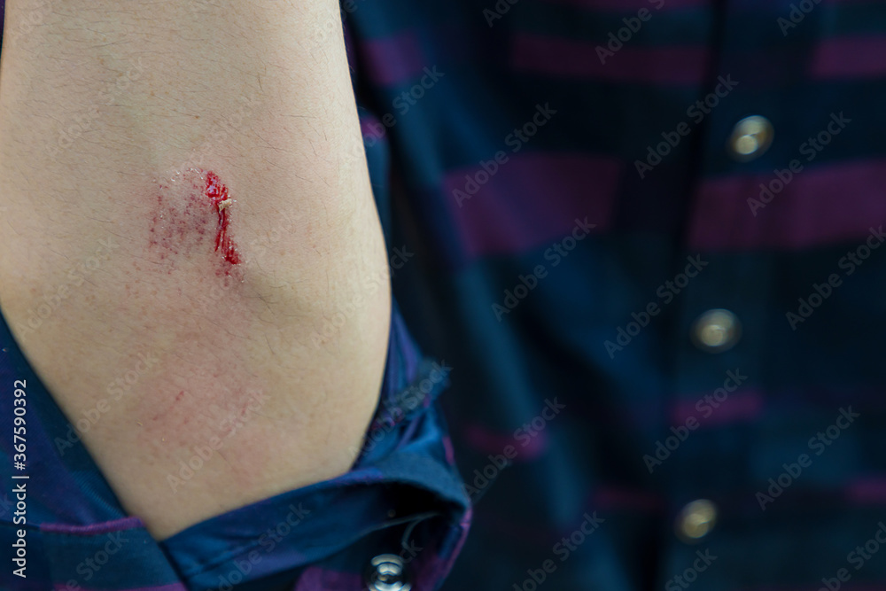 Fotografie Injuries from falling in the garden