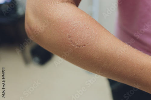 Toddler's bite marks on mothers arm - aggressive toddlers behavior psychology.