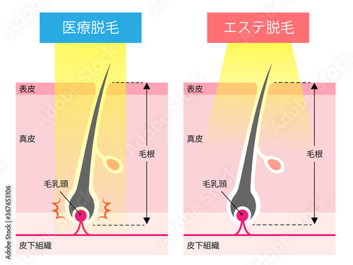 医療脱毛　エステ脱毛　肌の断面図