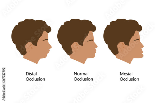 Guy with Distal, Normal, and Mesial bite profile, vector illustration. Overbite or underbite before and after orthodontic treatment. Human with malocclusion, bite correction by braces concept photo
