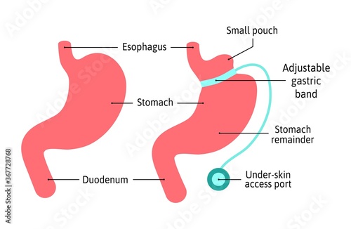 Gastric Band anatomical medical illustration diagram. Surgery divide stomach into two parts with band. Human stomach anatomy isolated on white background. Stomach and digestion organ system