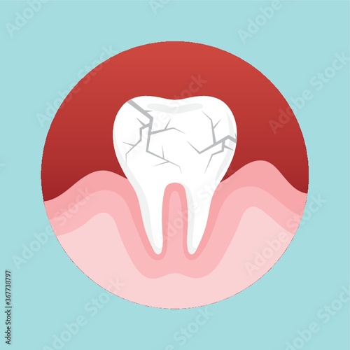 cracked tooth