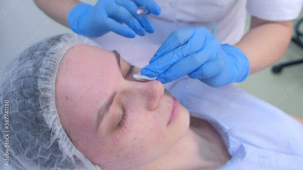 Cosmetologist doctor making multiple injections biorevitalization on woman face skin under eye, portrait closeup, side view. Mesotherapy lifting in beauty clinic. Beautician's hands and girl's face. Cosmetologist doctor making multiple injections biorevitalization on woman face skin under eye, portrait closeup, side view. Mesotherapy lifting in beauty clinic. Beautician's hands and girl's face.
