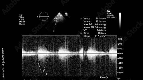 Image of the heart in gray-scale mode during transesophageal ultrasound.