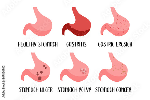 Stomach diseases. Gastritis, gastric erosion, ulcer, cancer, polyp. Gastroenterology. Vector flat illustration. Perfect for flyer, medical brochure, banner, landing page, website