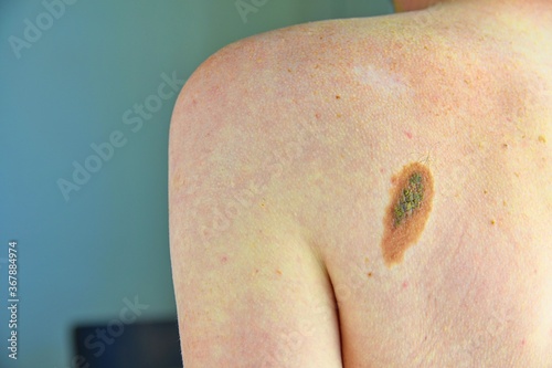 Hairy skin mole. Close up picture of dangerous brown nevus on human skin - melanoma photo