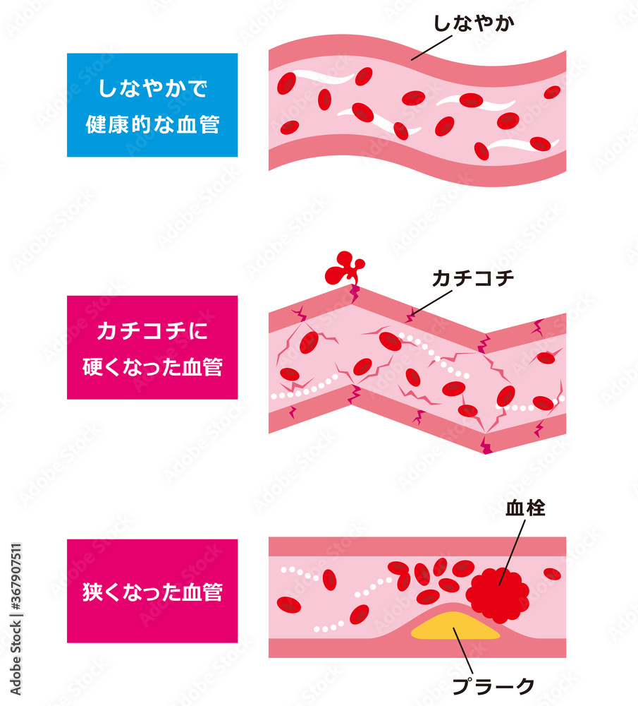 健康な血管　動脈硬化の血管