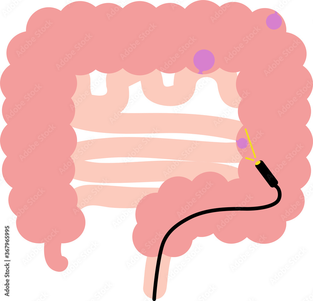 大腸ポリープのイラスト 内臓 消化器 検査 Stock Vector Adobe Stock 大腸ポリープのイラスト 内臓 消化器 検査 Stock Vector Adobe Stock