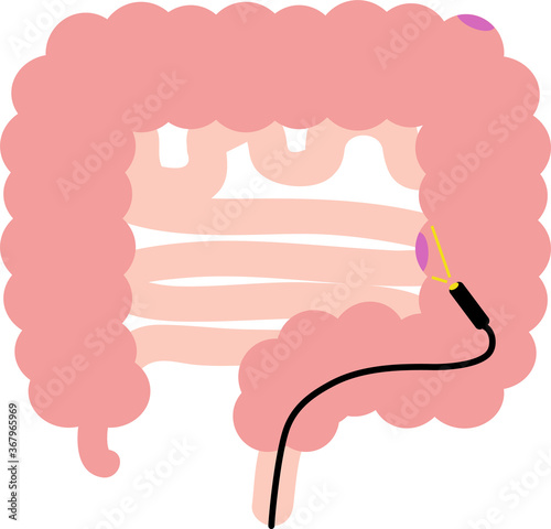 大腸ポリープのイラスト　内臓　消化器　検査