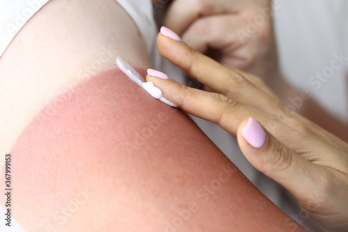 Foto Woman's hand applies cream to burn to treat sunburn