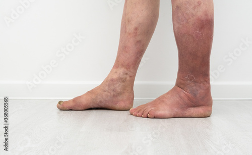  legs with lymphostasis and psoriasis.