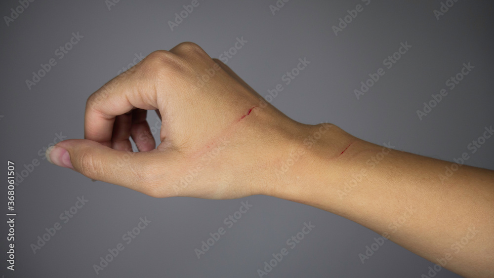 Cat Scratch Disease. A scratched female hand from a cat. Cat Scratch Disease. A scratched female hand from a cat.