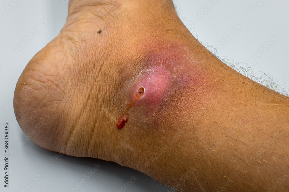 Naklejka premium Abscesses form after bacteria. Infected purulent open wound on the man's foot. 