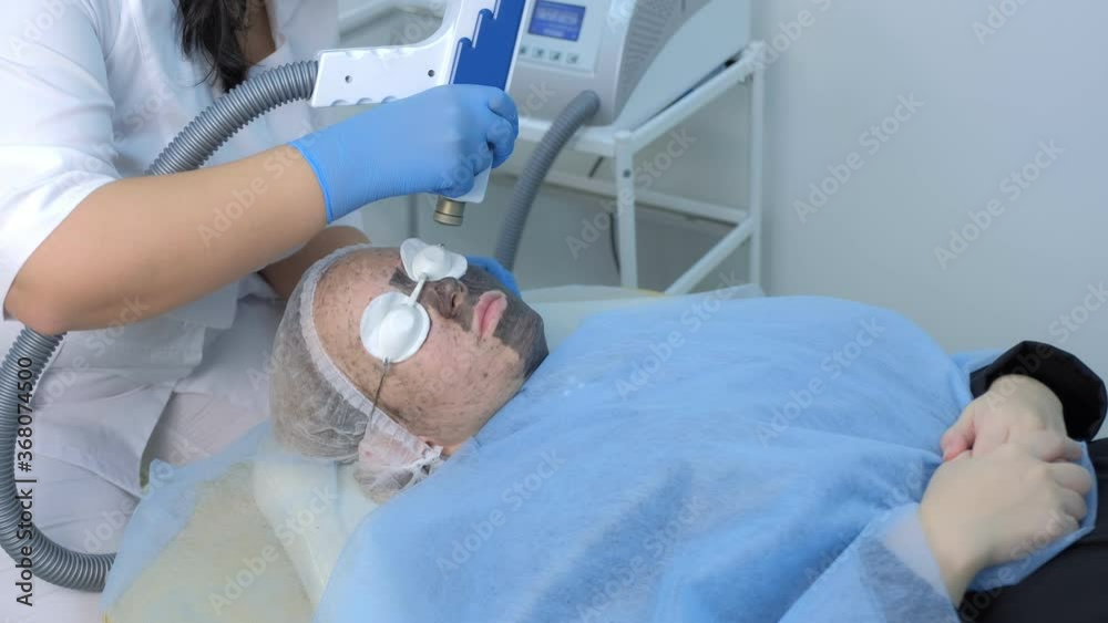 Cosmetologist making carbon face peeling procedure. Laser pulses clean skin of face. Hardware cosmetology treatment. Process of photothermolysis, warming skin, laser peeling. Facial skin rejuvenation. Cosmetologist making carbon face peeling procedure. Laser pulses clean skin of face. Hardware cosmetology treatment. Process of photothermolysis, warming skin, laser peeling. Facial skin rejuvenation.