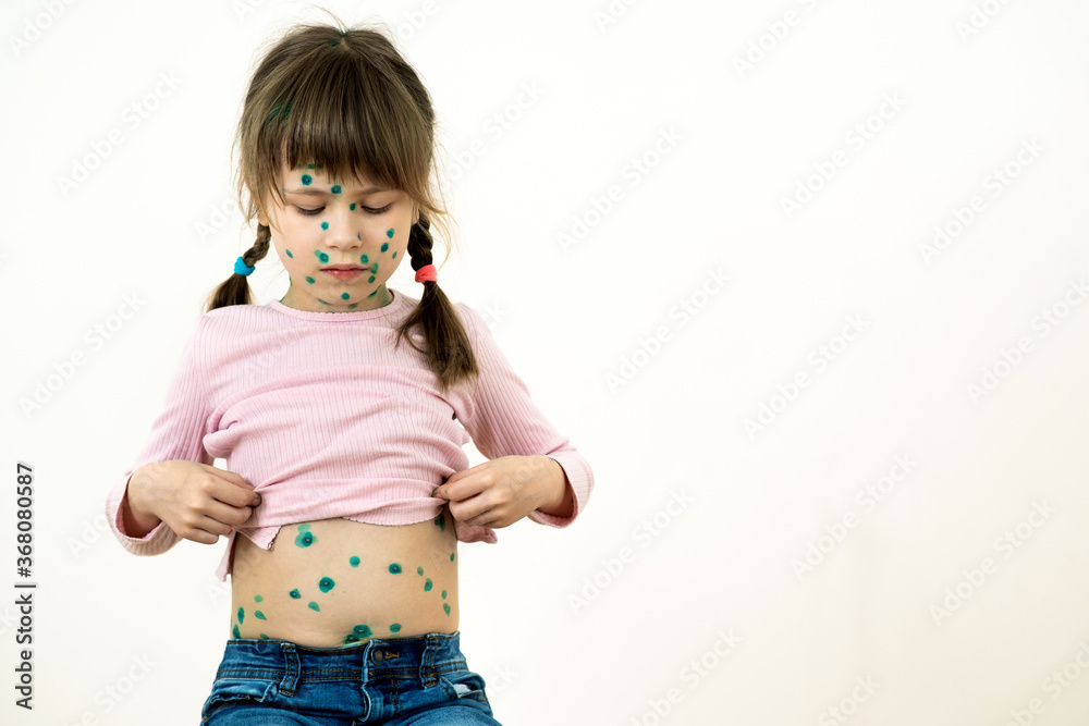 Child girl covered with green rashes on face and stomach ill with chickenpox, measles or rubella virus. Child girl covered with green rashes on face and stomach ill with chickenpox, measles or rubella virus.