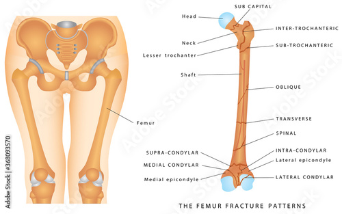 The Femur Fracture Patterns. Different kinds of fractures. Descriptive illustration with examples of fractures of the femur bone on white background. photo