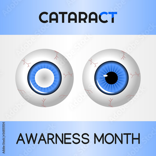 vector graphic of cataract awareness month good for cataract awareness month celebration. flat design. flyer design.flat illustration. awareness. eye.
