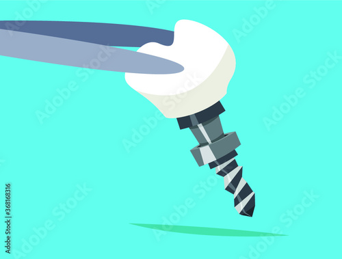 Schematic info-graphics of human teeth and dental implant.Healthy white tooth and gums illustration.