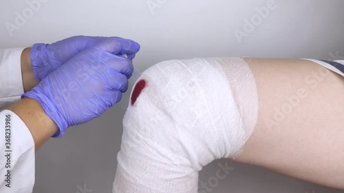 The doctor bandages the knee of a girl who is injured. Stopping bleeding by applying a pressure bandage to the injury. First aid for injuries. The technique of applying a cruciform bandage. photo