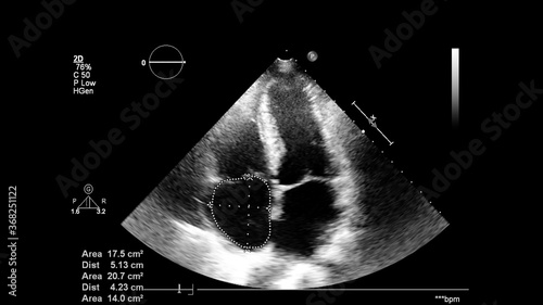Image of the heart in gray-scale mode during transesophageal ultrasound.