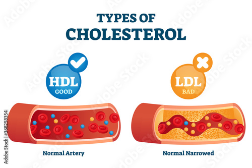 Cholesterol types comparison with HDL and LDL lipoprotein vector illustration photo