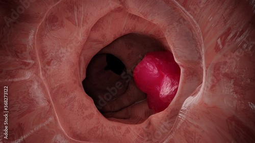 3D Animation of the colon during a enteroscopy with a intestinal or bowel cancer tumor visible.