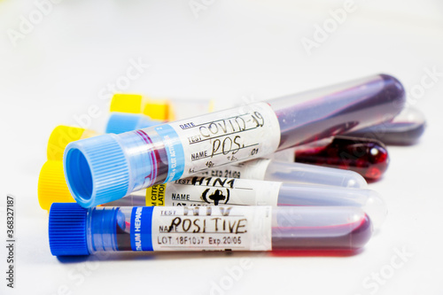 H1N1, Covid-19, Hepatitis C, Tuberculosis and Staphylococcus viruses blood tests in the tubes, laboratory diagnostics