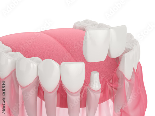 Foto 3d render of  jaw with dental cantilever bridge
