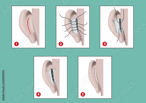 Otoplasty photo