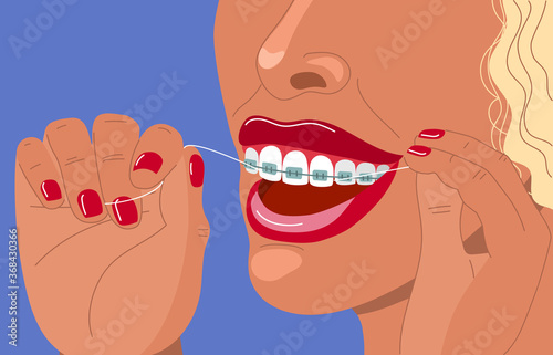 Cute blonde young woman with braces uses dental floss. Daily dental care. Correction of bite and a beautiful smile. Dental health and orthodontics. Stock vector flat hand drawn illustration.