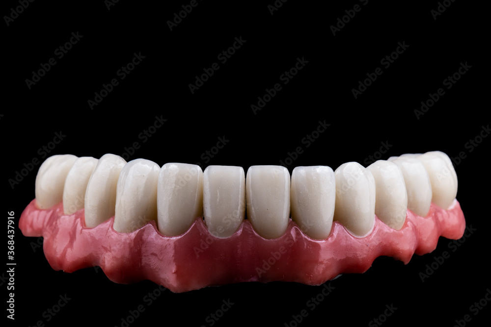 ceramic crowns done on 8 implants ceramic crowns done on 8 implants
