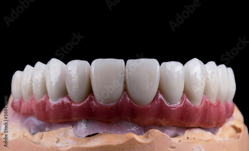 ceramic crowns done on 8 implants
