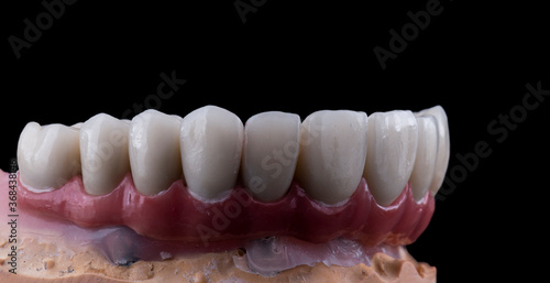 ceramic crowns done on 8 implants