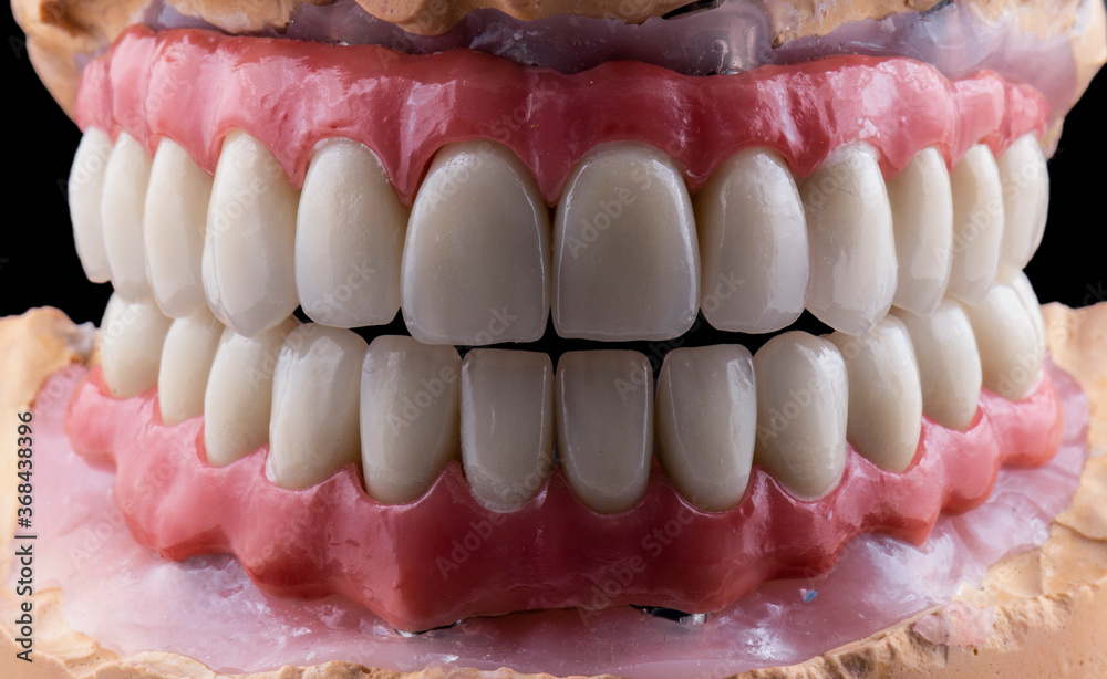 ceramic crowns done on 8 implants ceramic crowns done on 8 implants