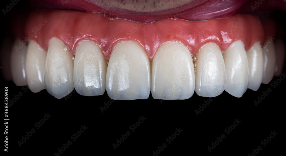 ceramic crowns done on 8 implants ceramic crowns done on 8 implants