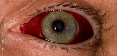 Human eye with subconjuctival hemorrhage, broken blood vessel, close up photo
