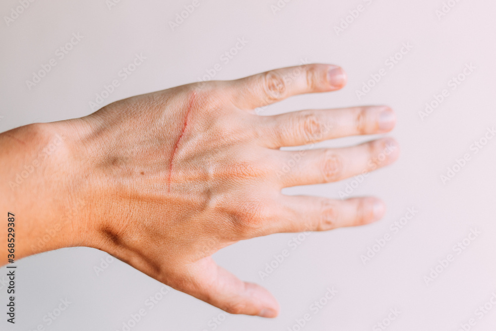 Fototapeta premium Man's hand with big fresh scratch made by cat. Injured arm in animal attack.