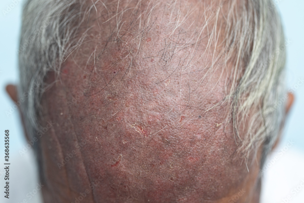 Naklejka premium A physical of Atopic dermatitis (AD), also known as atopic eczema, is a type of inflammation of the skin (dermatitis). 