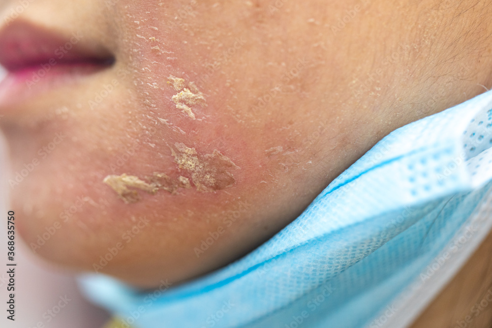 Fototapeta premium Backgrounds of lesions skin caused by acne on the face in the clinic. 