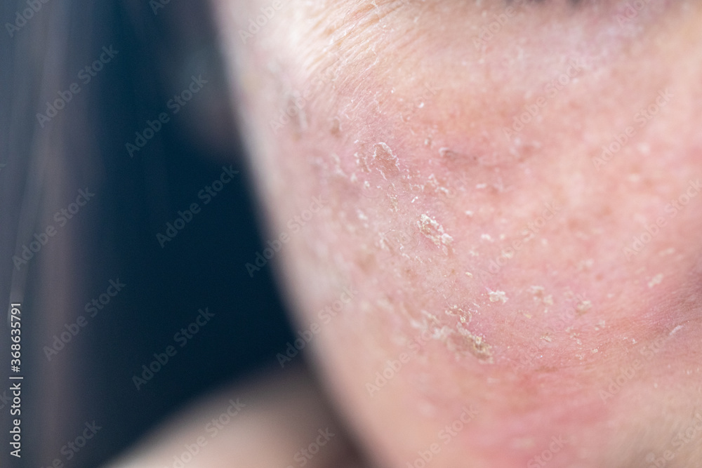 Fototapeta premium Backgrounds of lesions skin caused by acne on the face in the clinic. 