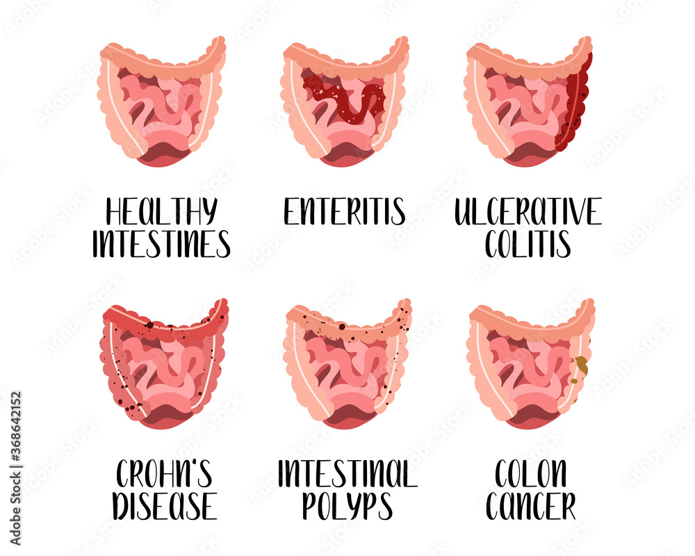 Intestines diseases. Enteritis, ulcerative colitis, Crohn's disease, polyp, colon cancer
