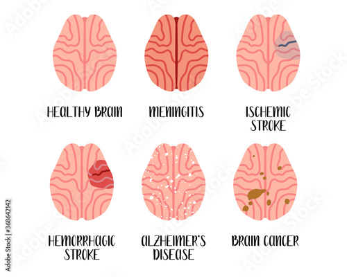 Brain diseases. Meningitis, ischemic and hemorrhagic stroke, alzheimer's disease, cancer. Neurobiology. Vector flat illustration. Perfect for flyer, medical brochure, banner, landing page, website