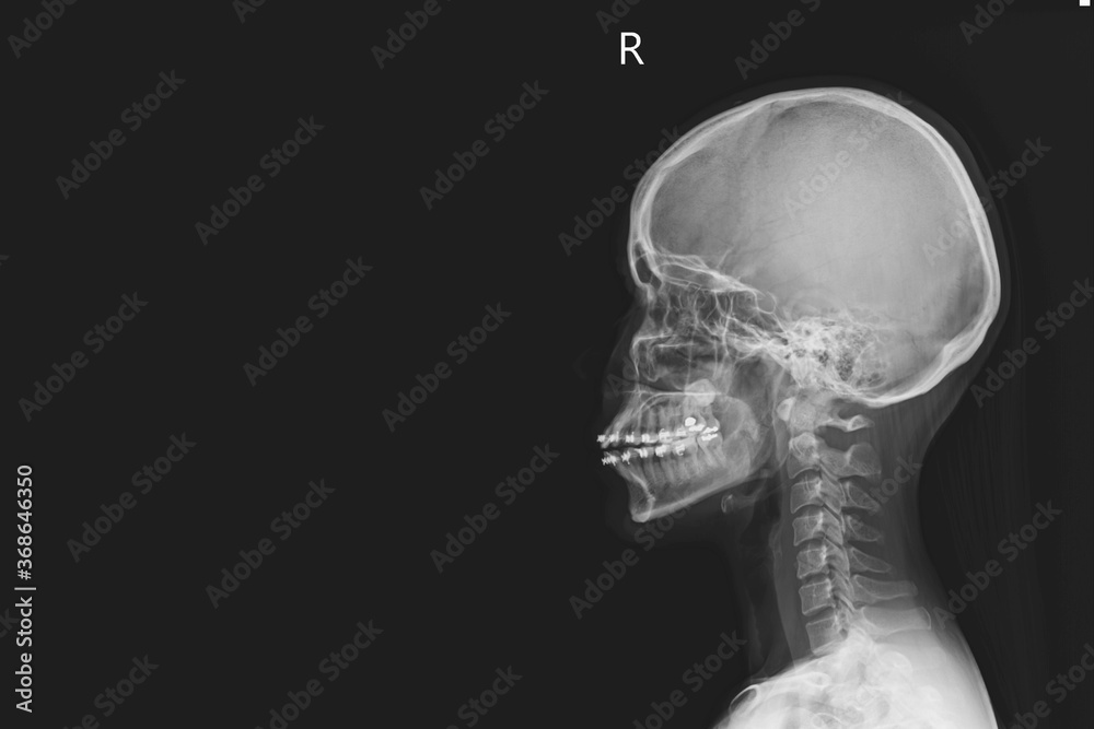 Fototapeta prześwietlenie ludzkiego kręgosłupa szyjnego i czaszki głowy.