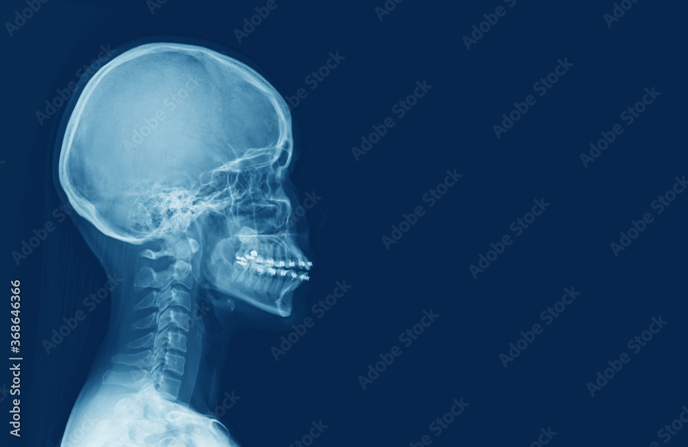 Fototapeta x-ray of human cervical spine and head skull
