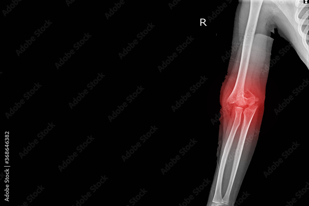 Xray Elbow joint Finding Supracondylar fracture distal humerus with